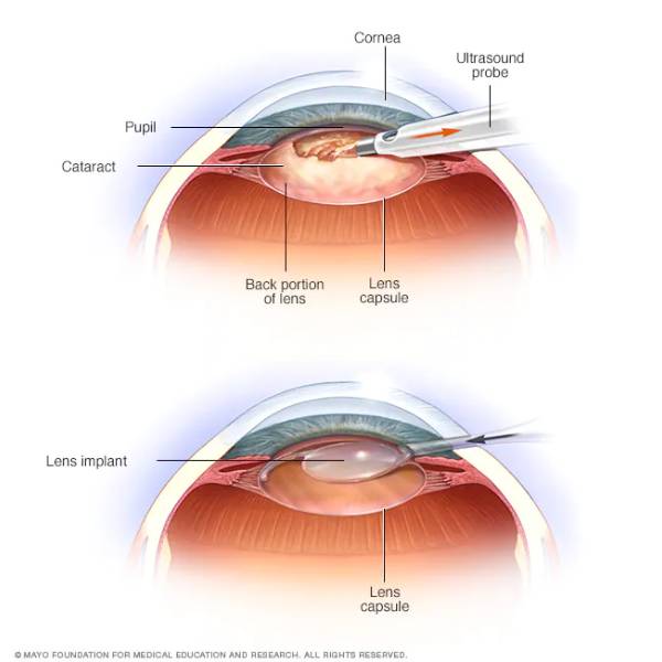 Eye Soul+Cataract Treatment