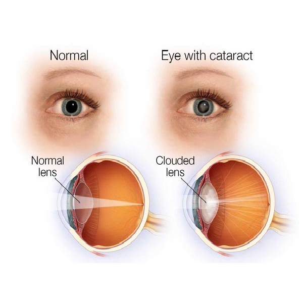 Noor Malabar Eye Hospital+Cataract