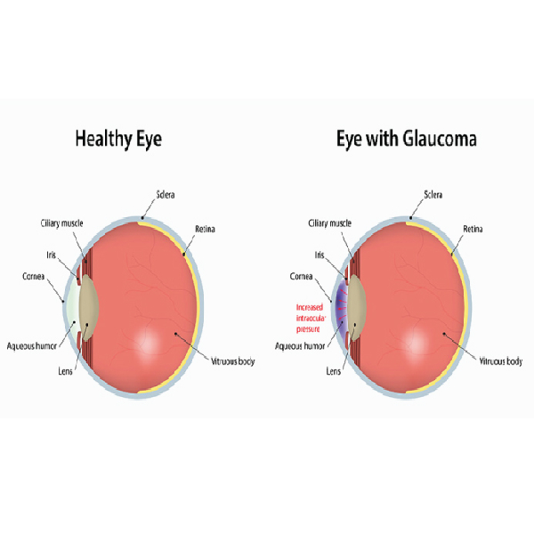 Noor Malabar Eye Hospital+Glaucoma